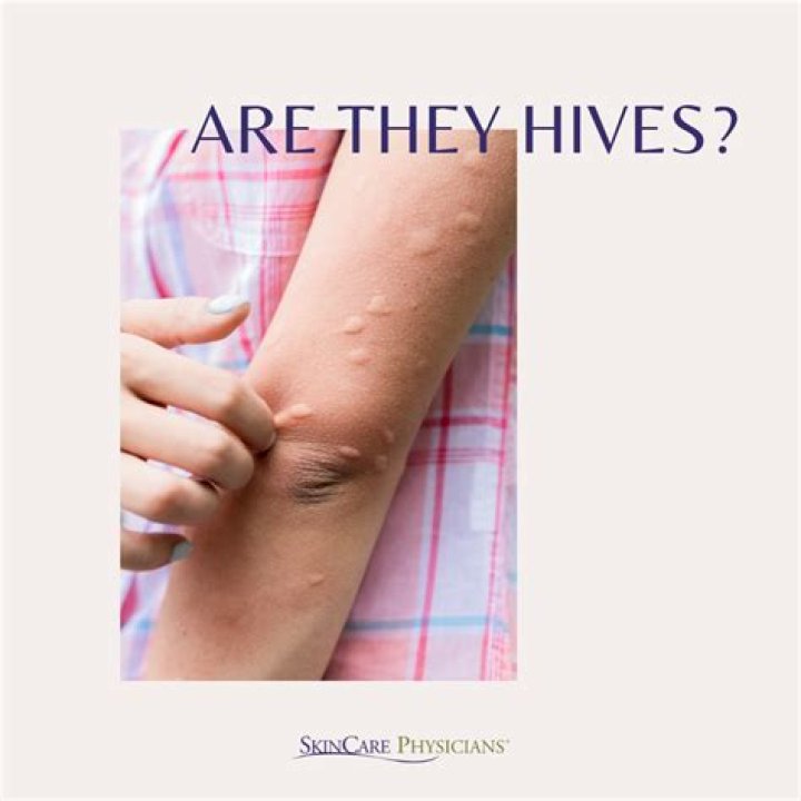 How do you calm hives?