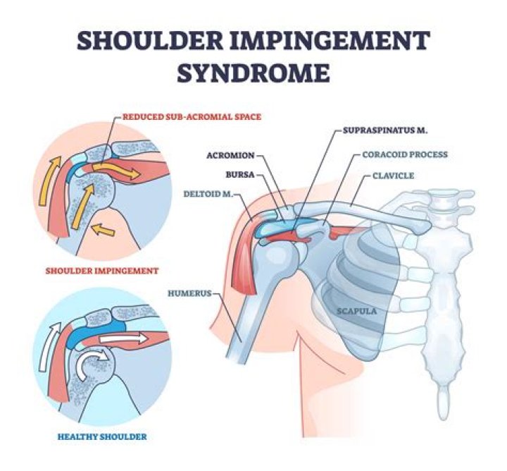 How do you fix arm impingement?