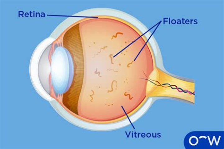 How do you fix floaters without surgery?