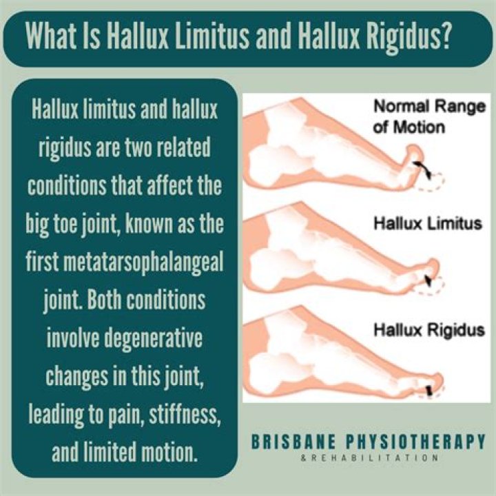 How do you fix hallux rigidus without surgery?