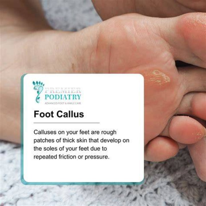 How do you get calluses on your feet?