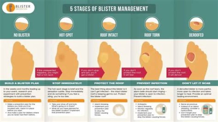 How do you get rid of a blister without popping it?