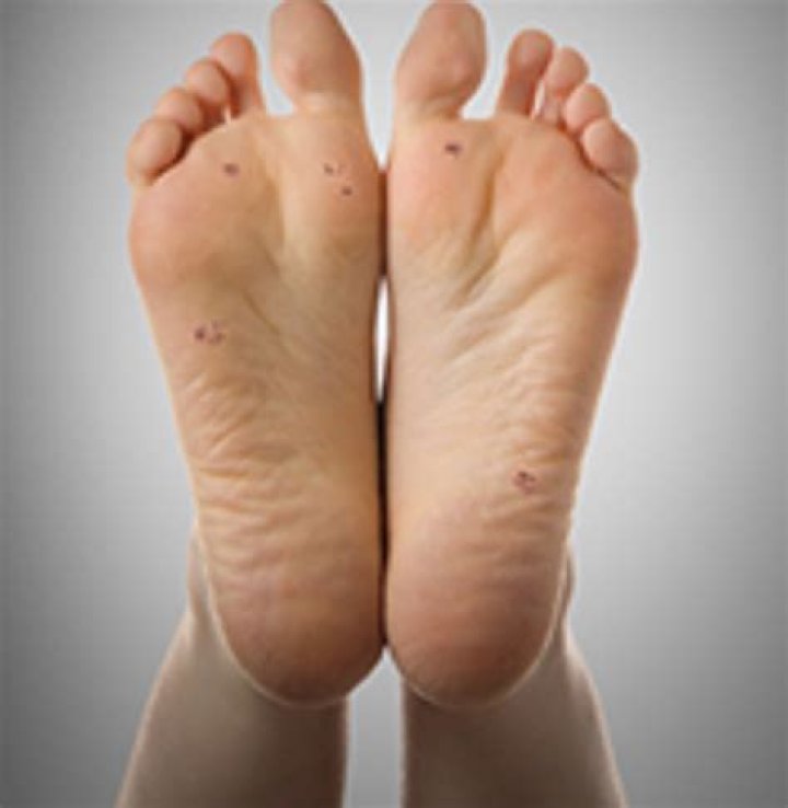 How do you get rid of hard spots on the bottom of your feet?