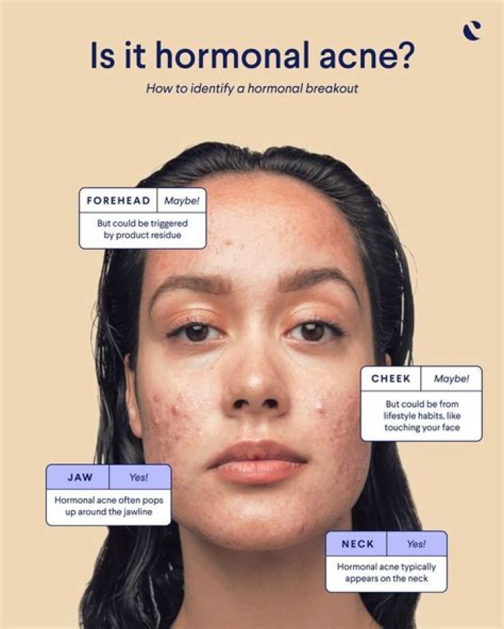 How do you get rid of hormonal acne fast?