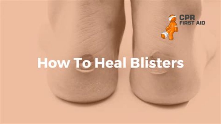 How do you heal a ripped blister?