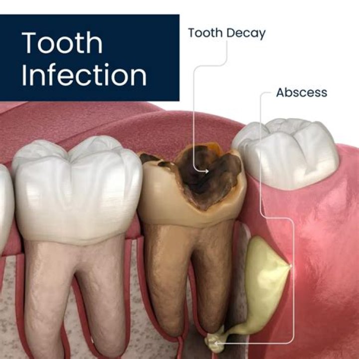 How do you know if the tooth is infected?