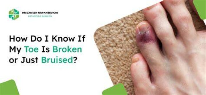How do you tell if a bone is broken or just bruised?