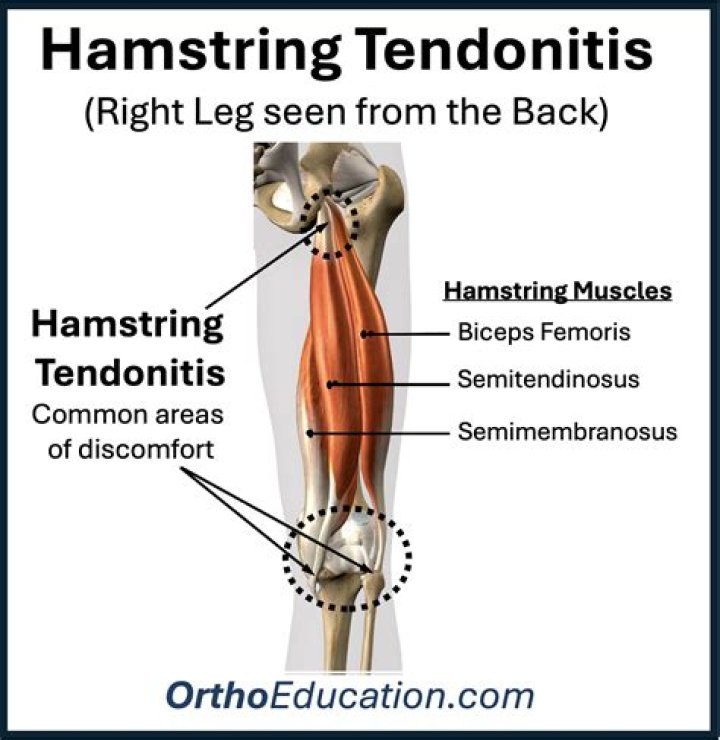 How do you tell if a tendon is torn or strained?