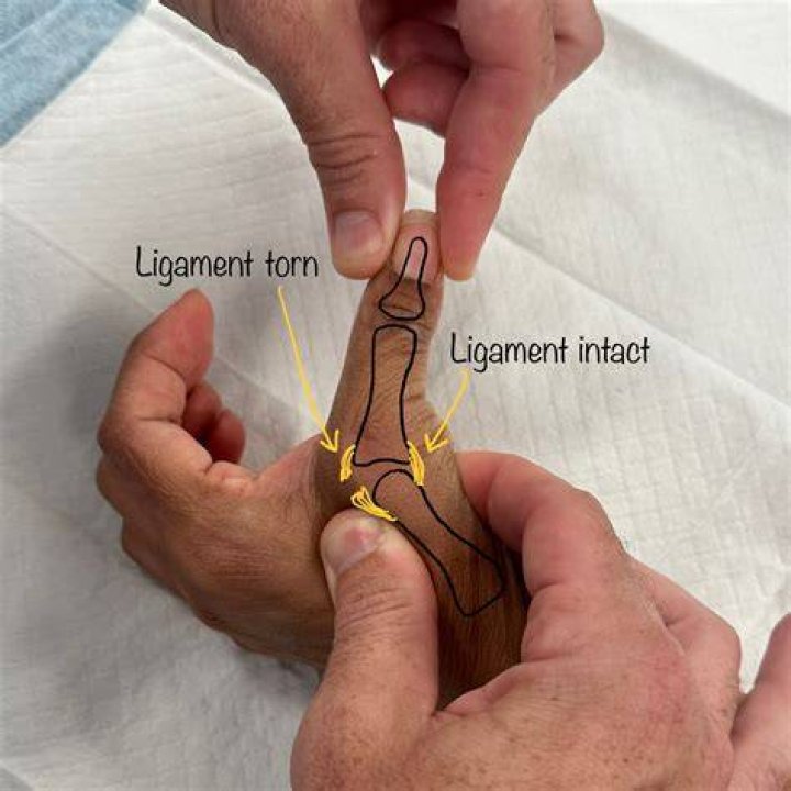 How do you tell if you have a torn ligament in thumb?