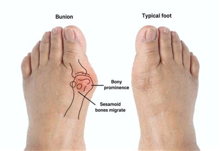 How do you tell if you have an extra bone in your foot?