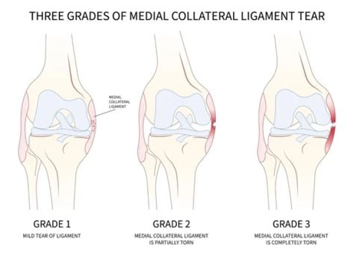 How do you treat a Grade 3 ligament tear?