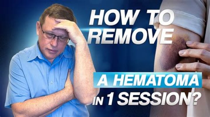 How do you treat a hematoma lump?