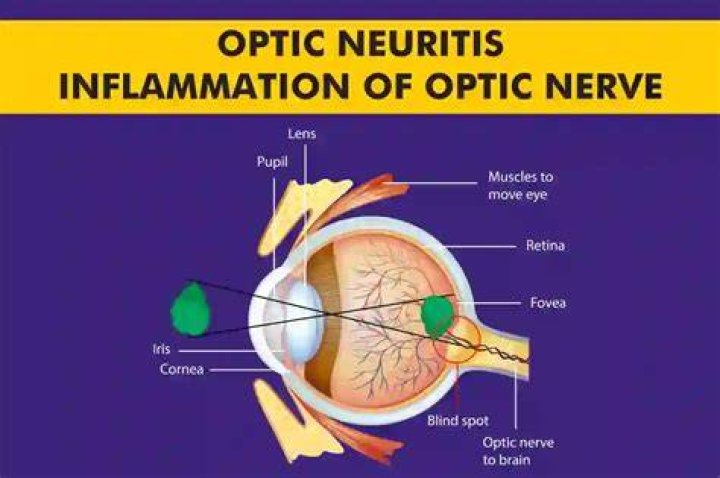 How do you treat nerve inflammation?