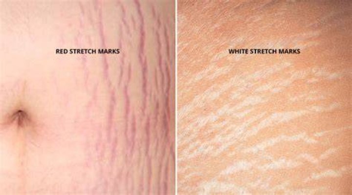 How does egg white get rid of stretch marks?
