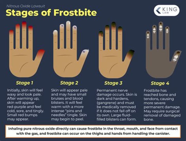 How fast can you get frostbite in?
