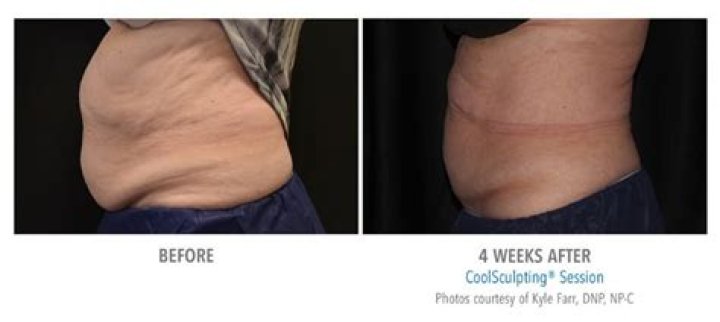 How fast do you see CoolSculpting results?