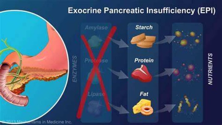 How is exocrine pancreatic insufficiency treated?