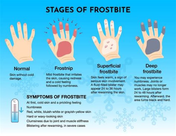 How long before frostbite turns black?