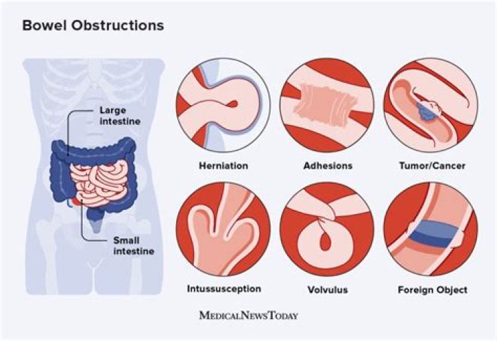 How long can a bowel obstruction go untreated?