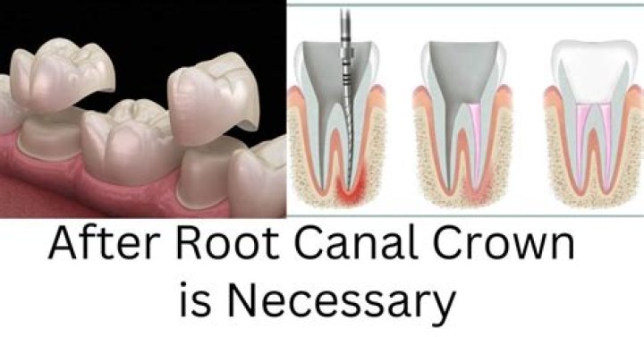 How long can I wait to get a crown after a root canal?