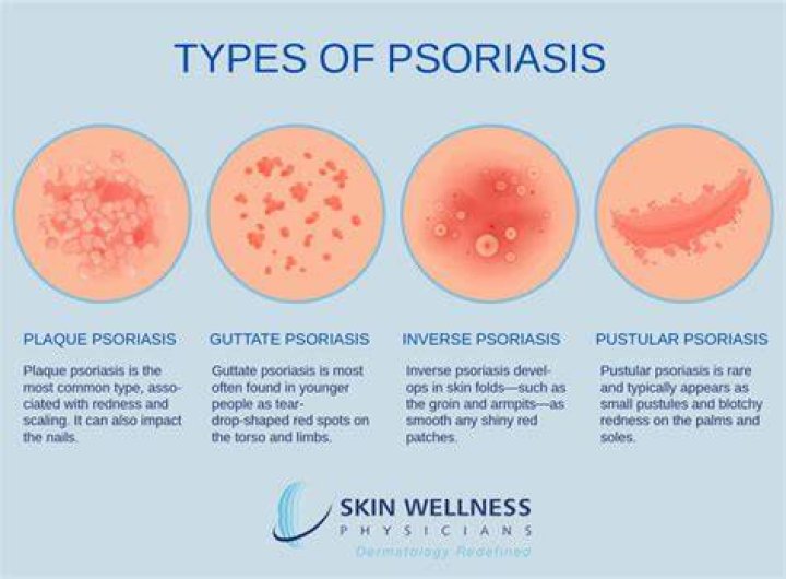 How long can psoriasis last?