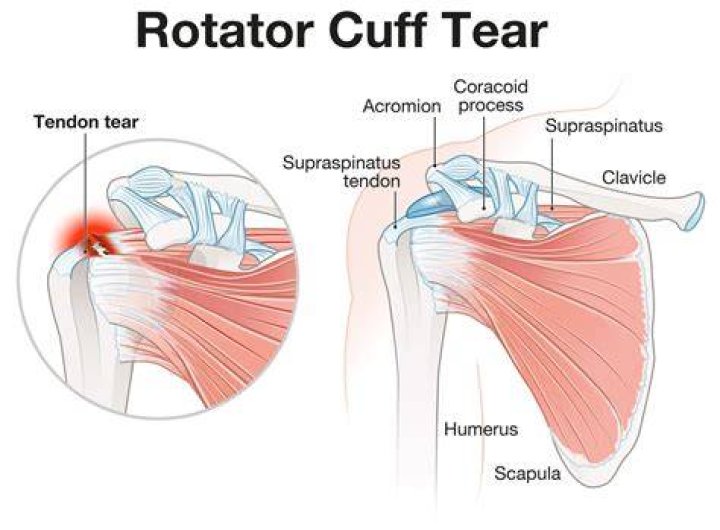 How long can you go with a torn rotator cuff?