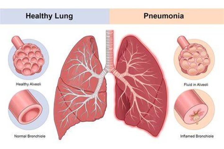 How long can you have pneumonia and not know it?