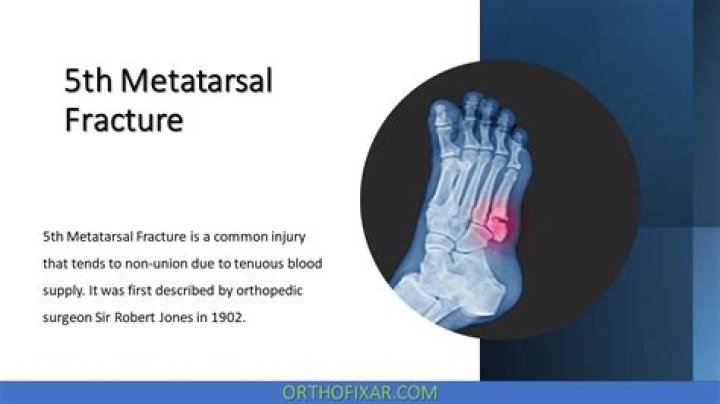 How long does a 5th metatarsal fracture hurt?