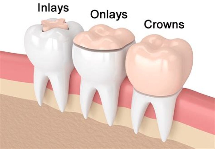 How long does an onlay last?