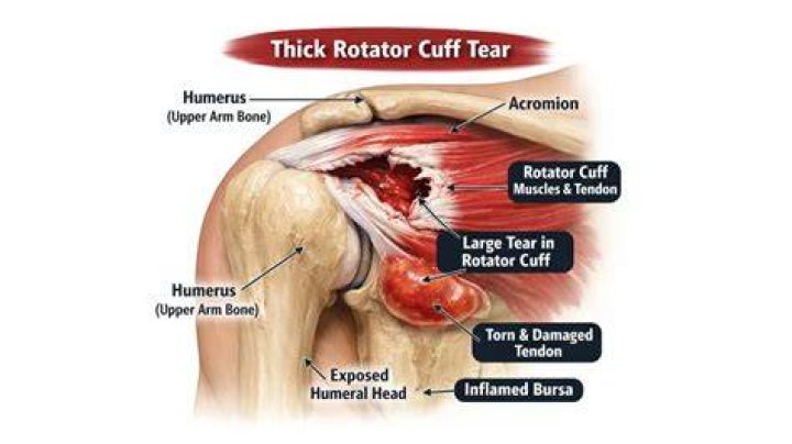 How long does it take for a rotator cuff tear to heal?