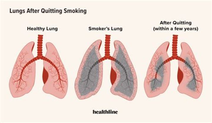 How long does it take for lungs to heal after pneumonia?