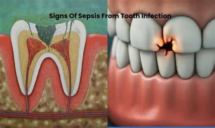 How long does it take to get sepsis from tooth infection?