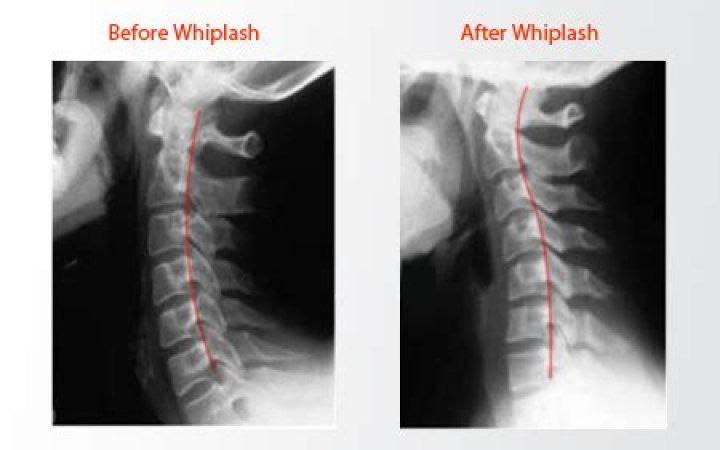 How long does whiplash last for?