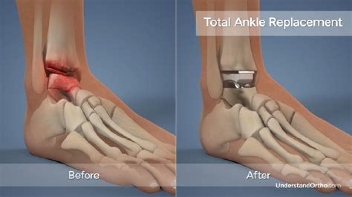 How long is bed rest after ankle surgery?