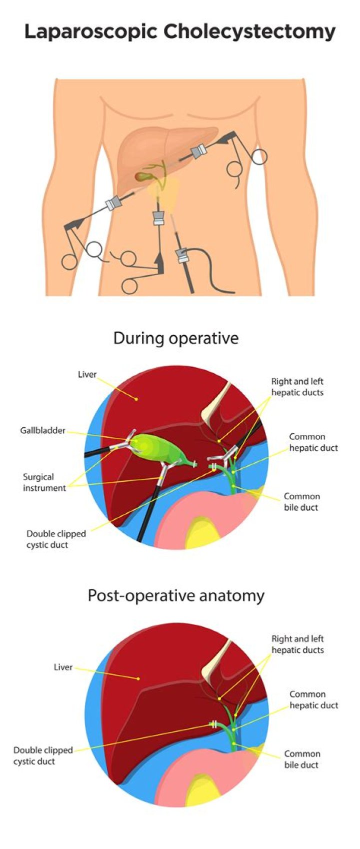 How long will my stomach be swollen after laparoscopy?