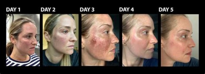 How many days it takes to glow after facial?