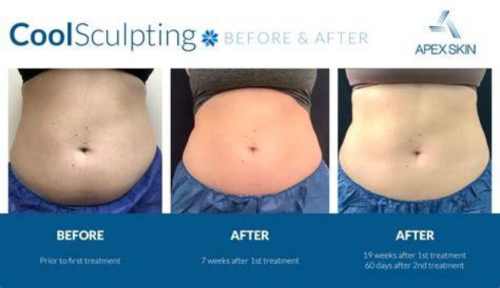 How many inches does CoolSculpting take off?