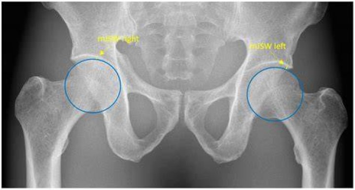 How many times can a hip be replaced?