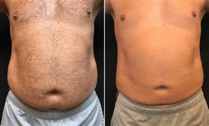 How much belly fat can CoolSculpting remove?