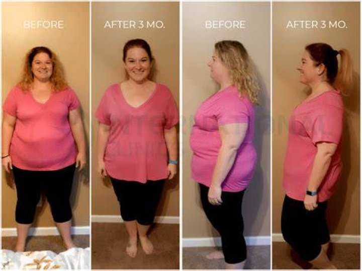 How much overweight do you have to be to get gastric sleeve?