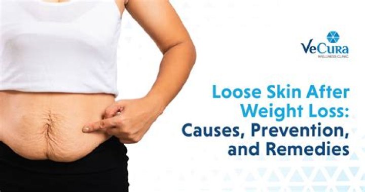 How much weight loss causes flabby skin?
