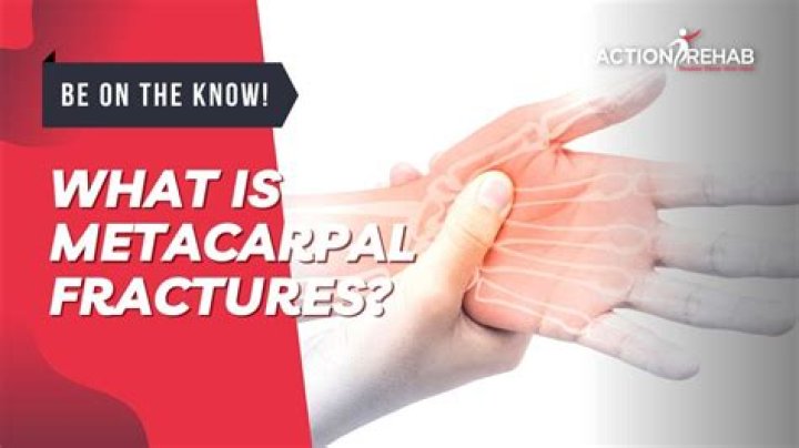 How painful is a metacarpal fracture?