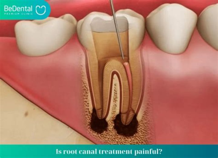 How painful is a root canal?