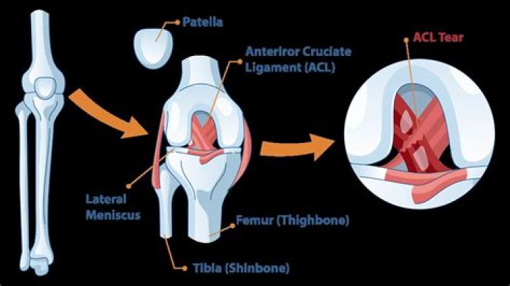 How painful is an ACL tear?