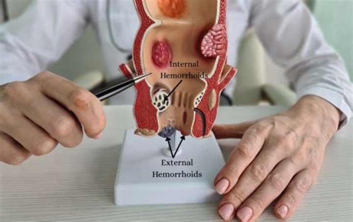 How painful is hemorrhoidectomy recovery?