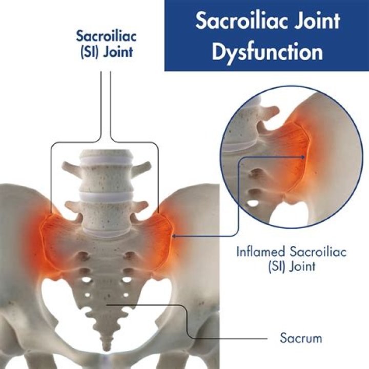 How serious is sacroiliitis?