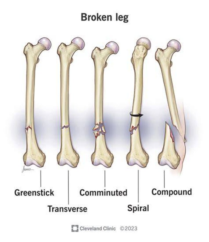 Is a broken bone more likely to break again?