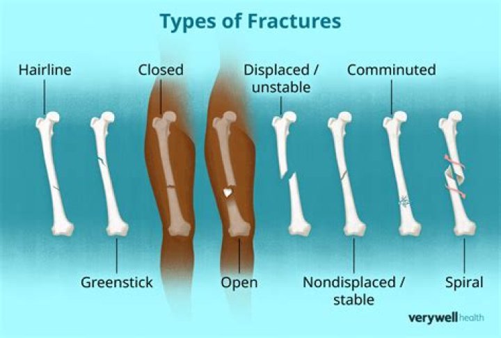 Is a fracture worse than a sprain?