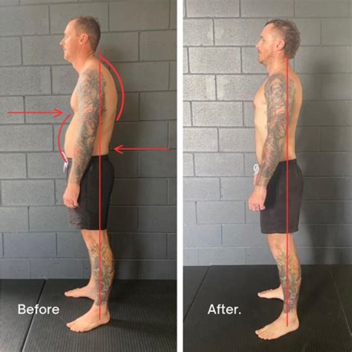 Is a hunched back permanent?