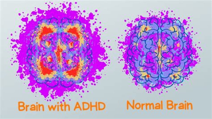 Is ADHD a neurological condition?